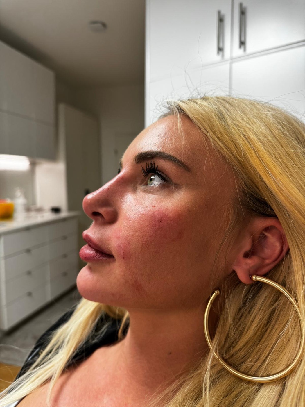 Augenringe unterspritzen in Berlin & Frankfurt